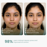 2% Salicylic Acid Syndet Soap for Acne and Oil Control – 75 g