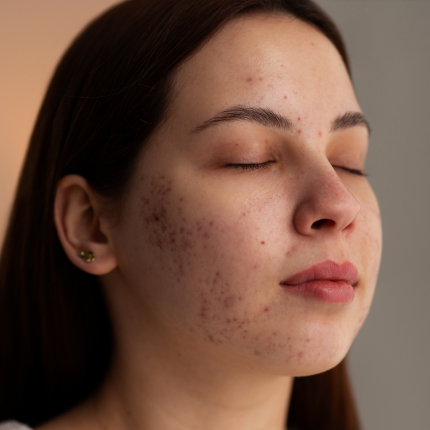 Top Dermatologist-Recommended Face Wash for Dark Spots in India 2026