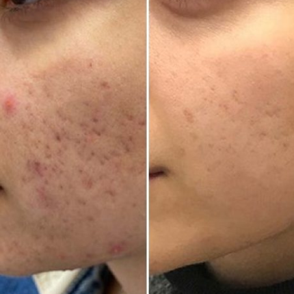 Best Soap for Acne Marks & Scars in India | Kojic Acid Soap