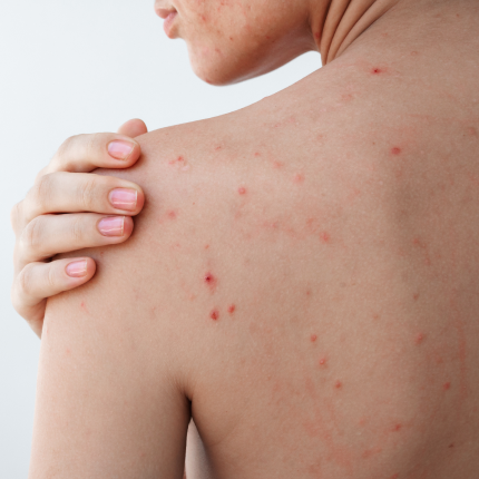 Best Soap for Back Acne (Bacne) in India | 2% Salicylic Acid Soap