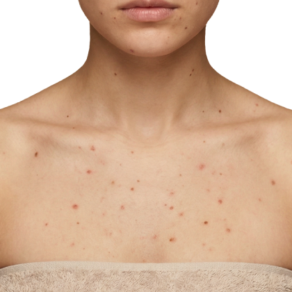 Best Soap for Chest Acne in India: Oil Control Soap with Salicylic Acid for Acne Prevention