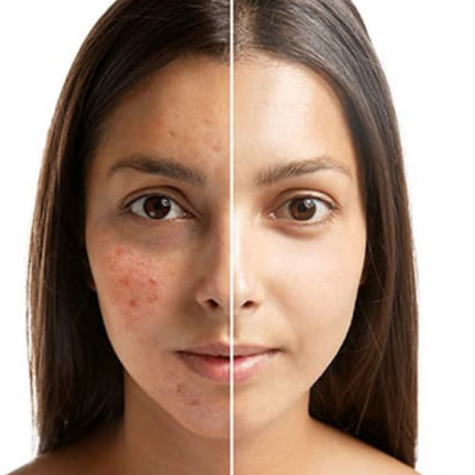 Best Soap for Dark Spots in India: Brightening Kojic Acid Formula for Even Skin Tone