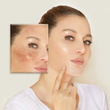 Best Soap for Melasma in India: Gentle Kojic Acid Soap for Skin Tone Correction & Care