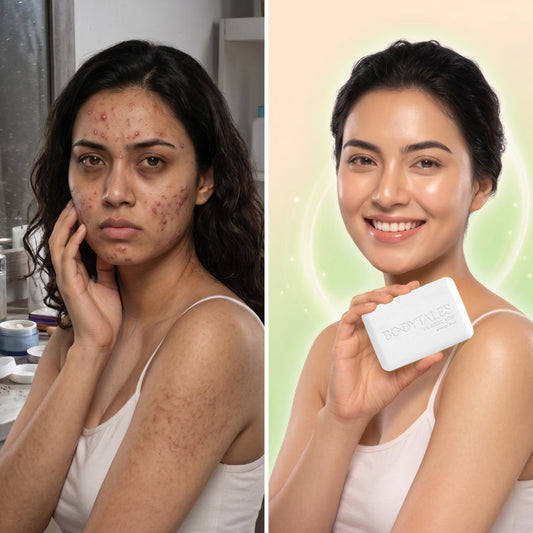 Best Soap for Pimples in India: Salicylic Acid Soap for Acne-Prone & Oily Skin
