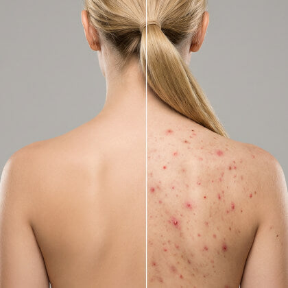 body acne treatment