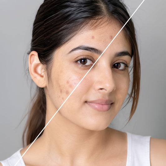 How to Prevent Post-Acne Marks: Skincare Tips | BodyTales