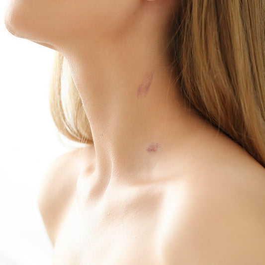 Love Bite Removal | BodyTales