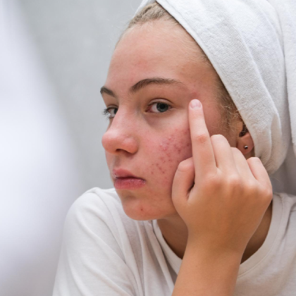 Morning & Night Skincare Routine for Acne-Prone Skin with Salicylic Acid