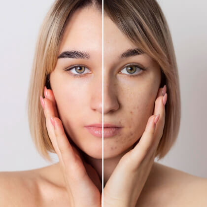 Pigmentation: Causes, Types, Prevention & Best Treatment Options